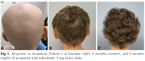 ©Tofacitinib for the treatment of alopecia areata in preadolescent children. Journal of the American Academy of Dermatology (J AM ACAD DERMATOL), Jul2020 83(1): 123-130. (8p)