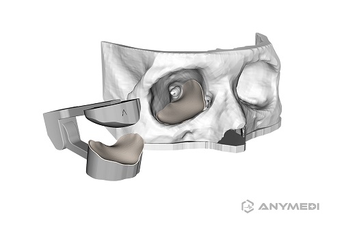 Anymedi Solution's orbital fracture implant guide cuts and processes the implant's curved surface and shape in the same way as the affected part by using a 3D printed patient-specific guide based on the patient's medical image (CT) information.