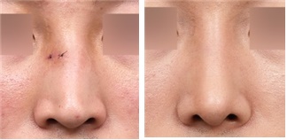 After broken nose surgery