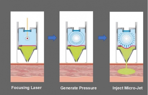 Mirajet’s technique. Explosion focused in the upper room of the nozzle forms the pressure that pushes down the membrane in the middle. That pressure makes the drug in the lower room to be injected.