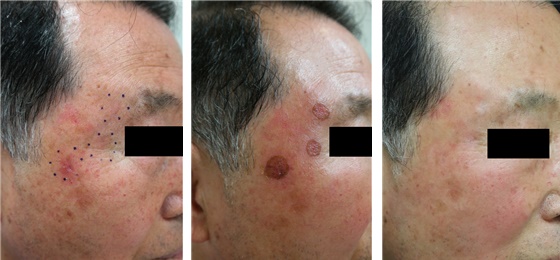 Cryotherapy for actinic keratosis. From the left, before treatment, 1 week after treatment, 6 months after treatment. After a week, you can see that the blister has subsided