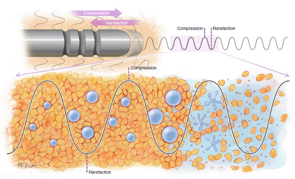 As the probe passes back and forth repeatedly, the tissue is compressed and relaxed. At this time, the tiny bubbles in the anesthetic solution develop more extensively and burst, damaging the surrounding fat cells. (Source: "High Definition Body Sculpting: The Art and Advanced Techniques of Liposuction" by Alfredo R. Hoyos and Peter M Prendergast, published by Springer, page 75).