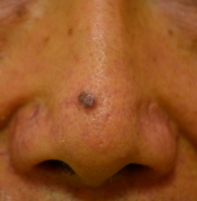 Basal cell cancer, which is challenging to distinguish from what occurred at the tip of the nose (photographing = Professor Heo Chang-Hoon of Seoul National University Bundang Hospital)