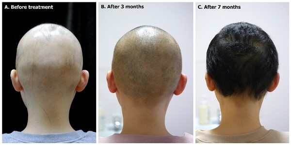 Alopecia totalis treated by Pallas laser. A: Before, B: After 3 months, C: After 7 months (photos from Laser in Medical Science 2020;35:999-1002).