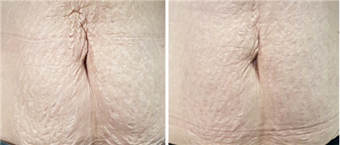 Mirajet injector Before(left) and After(right): improvement of stretchmarks on the belly