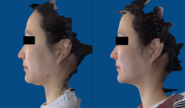 Before (left) and after jawline correction (Photo=Provided by Director Yoon Seong-Jae).