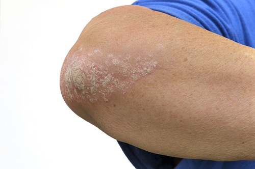 Psoriasis is a chronic condition that requires lifelong management, characterized by the accumulation of thick, scaly skin layers with distinct borders (Photo: Clipart Korea).