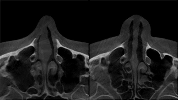 Left is the nose with nasal valve stenosis and on the right is a normal nose.
