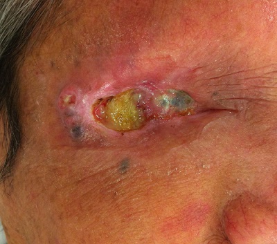 Underlying cell cancer that invaded the eyeball by refusing treatment (photo courtesy of Heo Chang-Hoon, professor at Bundang Seoul National University Hospital)