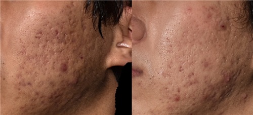 Mirajet injector Before(left) and After(right) : recovering acne scar
