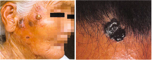 Squamous cell carcinoma, basal cell carcinoma (Source = Dermatology 7th Edition)