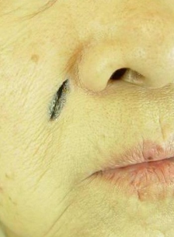 Basal cell carcinoma, which was mistaken for a mole and deteriorated after multiple laser treatments (Photo courtesy of Seoul National University Bundang Hospital, Professor Chang-Hoon Huh)