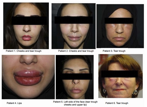 Cases of various side effects reported in the Delayed Hypersensitivity Reaction to Hyaluronic Acid Dermal Filler Following Influenza-like Illness published in 2019.