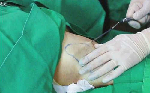 Superficial liposuction has been recently performed as one of the treatments for bronchitis (Source = Journal of Korean Dermatology 2015;53:523-529).