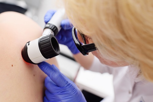 Magnifying microscope dermoscopy. Through this, lesions 2-3 mm below the skin surface and structures up to the upper dermis can be directly seen so that skin cancer can be diagnosed without needing a biopsy.