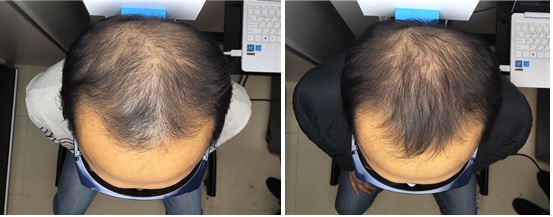 LG Electronics’ hair loss treatment laser: before treatment (left) and after 4 months of treatment (right) on the top of the head.