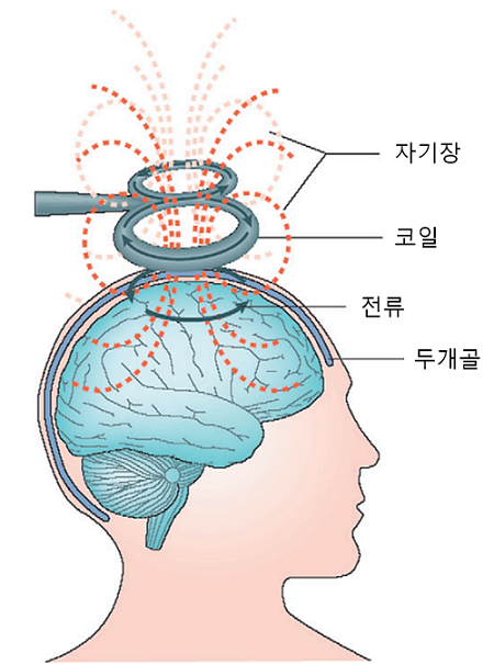 The principle of transcranial magnetic stimulator. A magnetic field made from a coil passes through the skull and creates an electric current in the brain to heal. (Source = Neurofeedback, Neuromodulation Techniques, and Applications (published in 2011) P 258).