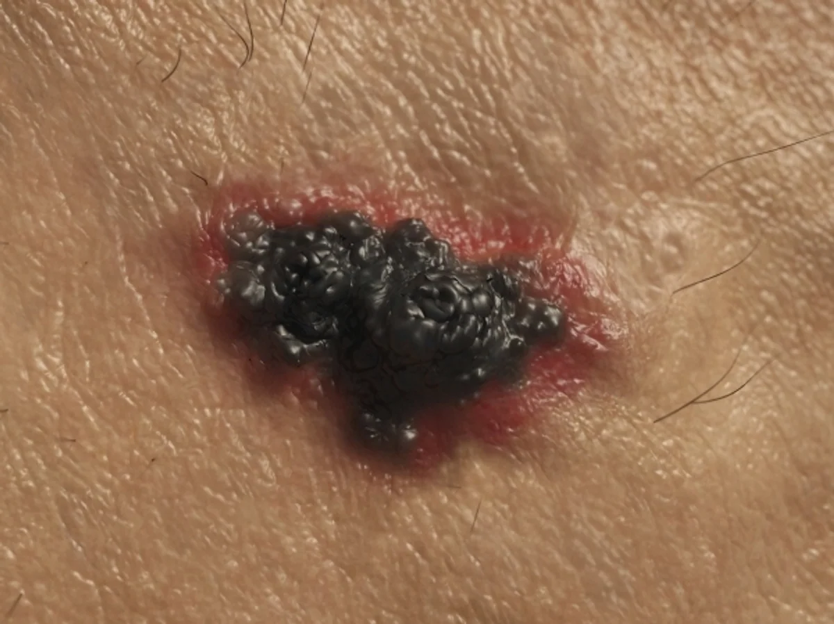 Understanding Moles and Melanoma: Key Characteristics and Diagnosis