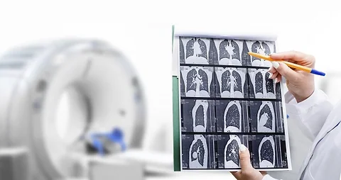 Innovative Approaches to Lung Cancer Treatment
