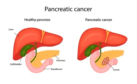 Innovative Advances in Pancreatic Cancer Treatment