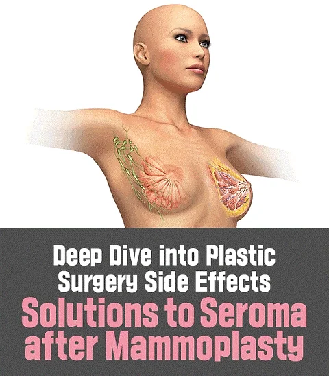 Understanding Seroma: A Complication After Mammoplasty