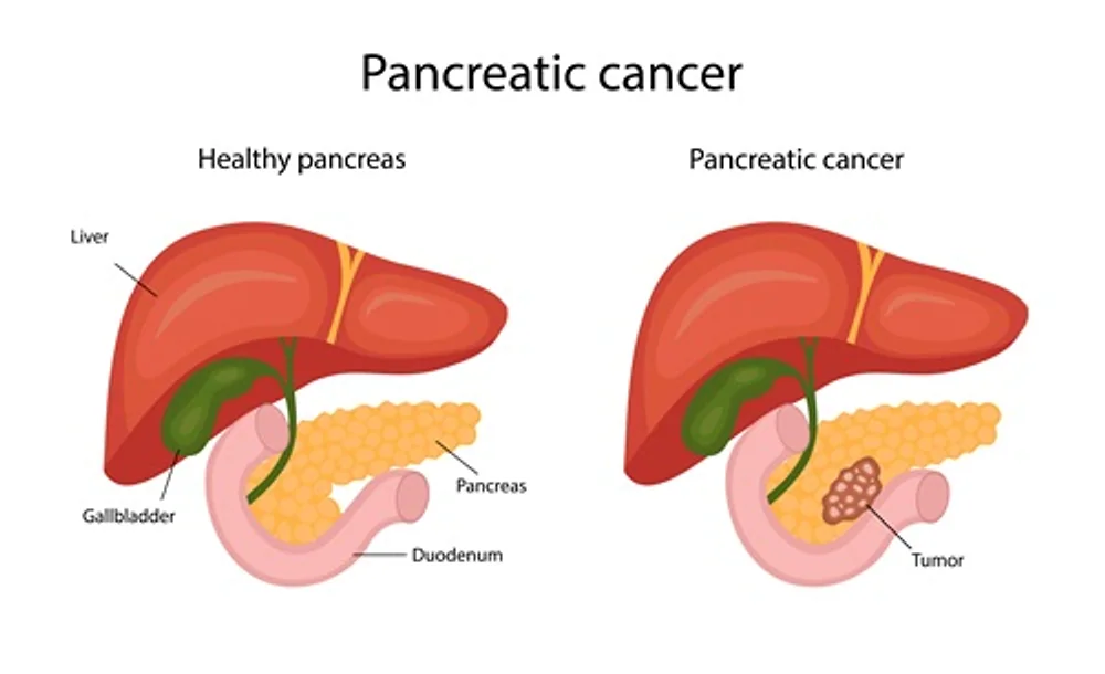 Revolutionary Advances in Pancreatic Cancer Treatment