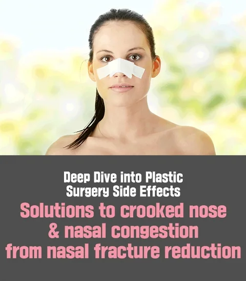 Understanding Nasal Bone Fracture and Its Treatment