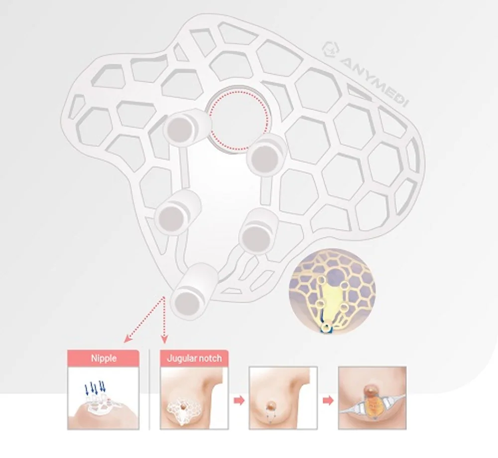 Innovative 3D-Printed Surgical Guide for Breast Conserving Surgery