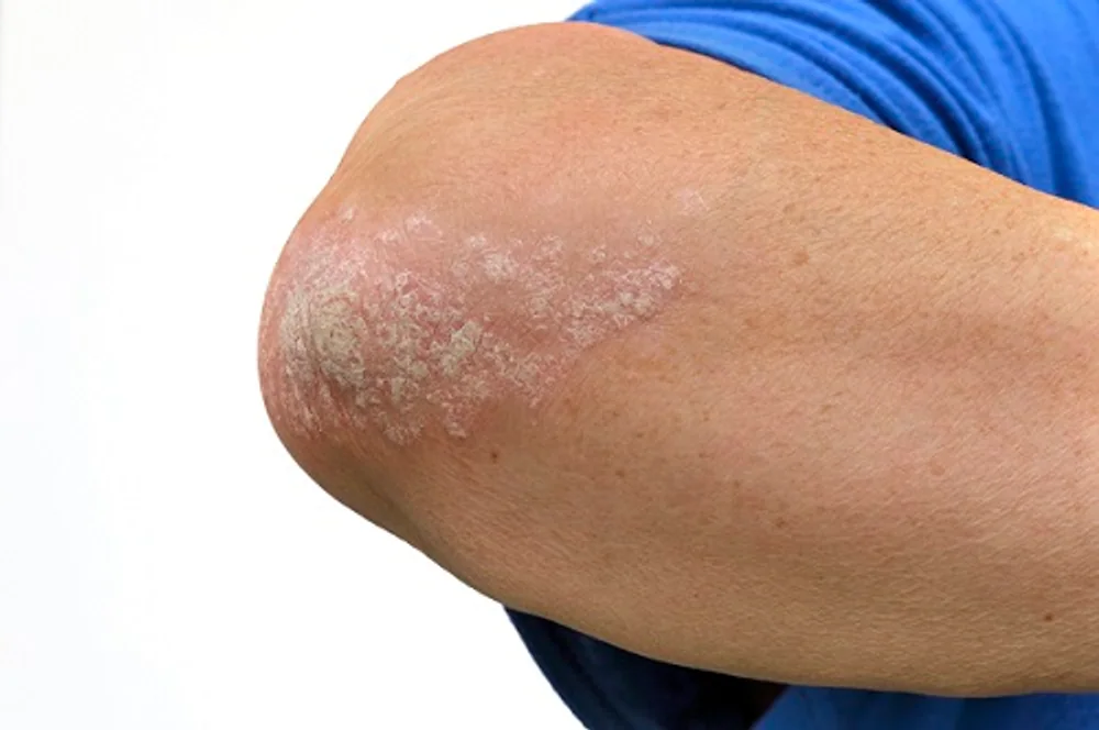 Understanding Psoriasis: Debunking Misconceptions and Managing Treatment