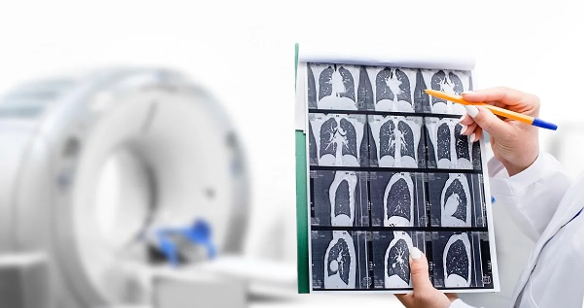 The Evolution of Lung Cancer Care