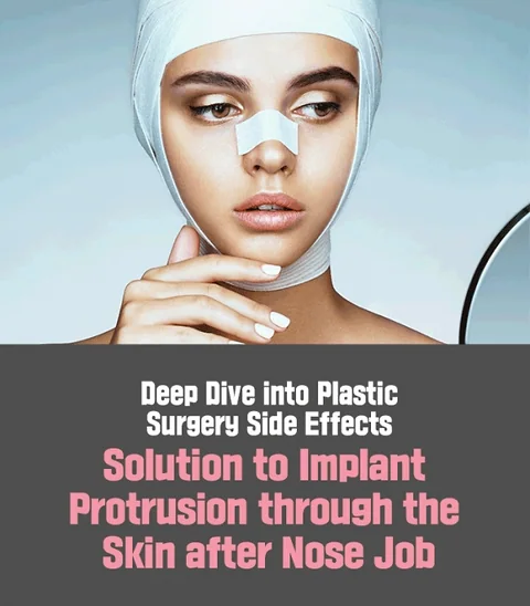 Understanding the Risks and Management of Rhinoplasty Side Effects