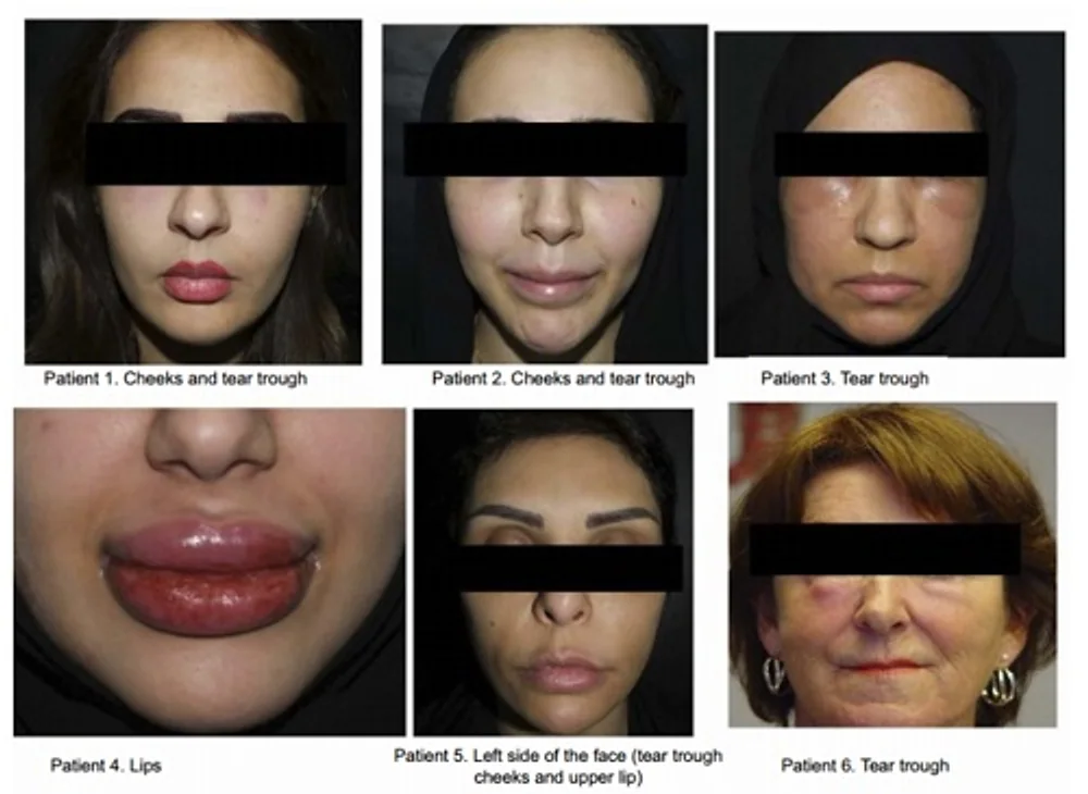 The Emerging Concerns of Delayed Hypersensitivity in Hyaluronic Acid Dermal Fillers