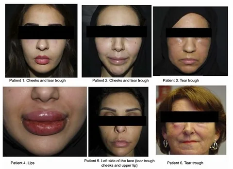 The Emerging Concerns of Delayed Hypersensitivity in Hyaluronic Acid Dermal Fillers