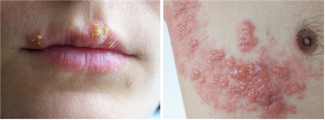 Understanding Herpes Simplex and Herpes Zoster: Differences and Treatment Approaches