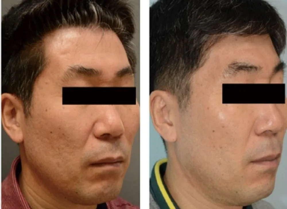 Innovative Laser Treatments for Acne Scarring